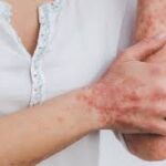 List of Psoriasis Ayurvedic Medicine in India